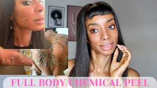 CHEMICAL PEEL  Full Peeling Process BEFORE amp AFTER  How To Get Rid of Hyperpigmentation [upl. by Mages]