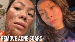 MY FULL BODY CHEMICAL PEEL EXPERIENCE  ON SENSITIVE SKIN OF COLOR [upl. by Ahsena533]