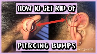 HOW TO GET RID OF PIERCING BUMPS [upl. by Ahseral125]