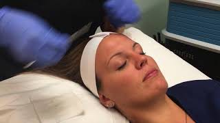 Miras chemical peel recovery daybyday [upl. by Bayless]