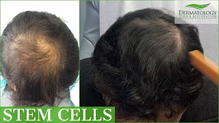 STEM CELL  PRP Therapy for Hair Loss with THREE MONTH UPDATE [upl. by Jeritah80]