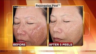 First Chemical Peel Experience  Results Before amp After [upl. by Lamdin]