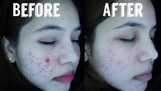 My 3rd Laser for ACNE  Does it help [upl. by Mis]