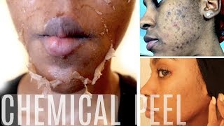 HOW TO Make a NATURAL Chemical Peel AT HOME  ERASE ACNE WRINKLES amp DARK SPOTS [upl. by Nospmoht721]