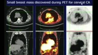 PET CT Scan [upl. by Gunn171]