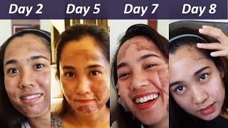 Stomach Chemical Peel Post Baby Full Process  Procedure  Peeling  Before amp After [upl. by Aket]