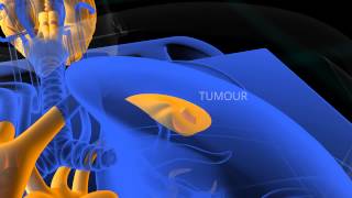 PET Scan animation [upl. by Merrel]