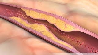 What is Atherosclerosis [upl. by Lehcor]